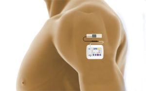 Peripheral Nerve Stimulator - Pain management clinics in Las Vegas