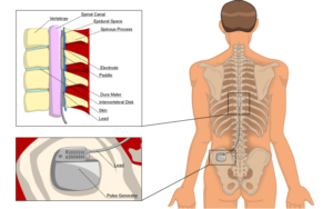 peripheral nerve or dorsal column stimulator