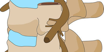 Neurostimulator Las Vegas