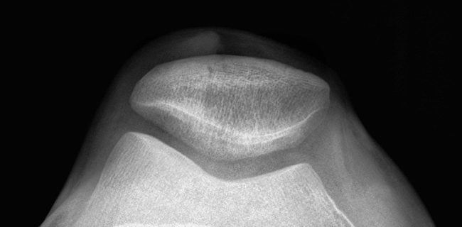 knee-pain 5 Treatments For Knee Pain | NVCPC.com
