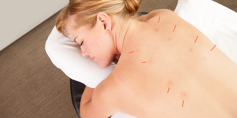 Top 5 Benefits Of Acupuncture | NVCPC.com